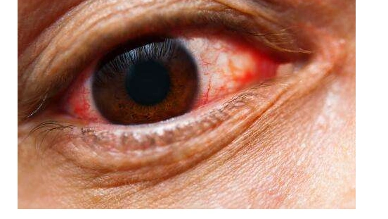 白眼球发蓝暗示着缺铁性贫血比较严重,双眼4个病症,你中好多个?