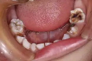 蛀牙的那些事,你都了解吗?