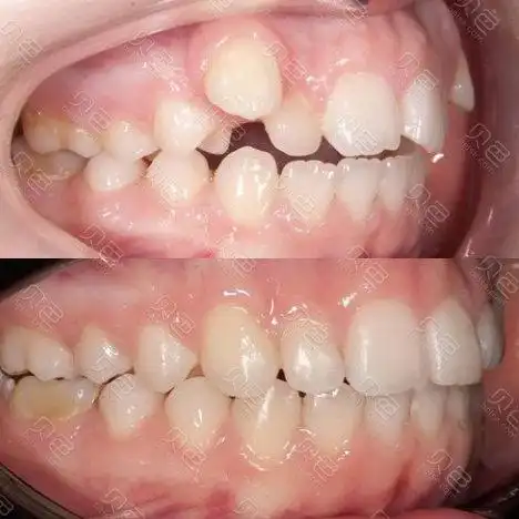 "虎牙妹变形记"搞定两颗虎牙从此土包子变小仙女