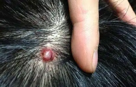 痘痘,是身体在给我们"通风报信",2种植物给它治好|葡萄球菌|头皮|牛蒡