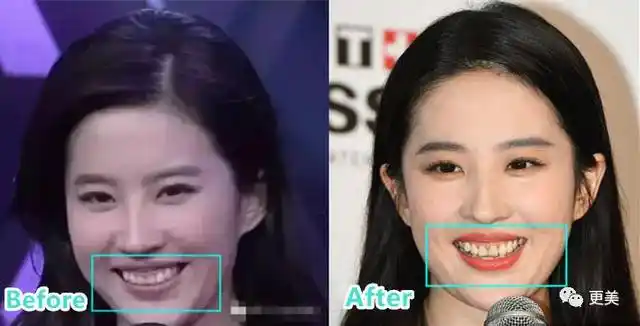 其实纯天然的刘亦菲也没有忍住,偷偷去整了这儿