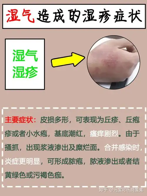 从舌头的状态判断自己是否有湿气附带湿疹方法