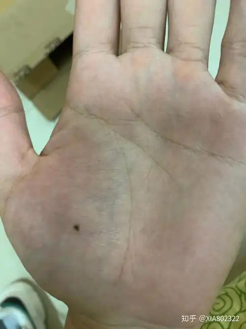 本人女,十八九岁时左手掌长了个痣是什么原因?