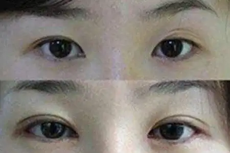 丹凤眼割双眼皮的注意事项 整容前后对比让你一目了然