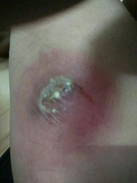 我爸大腿上长了个疖子,去医院医生用刀割了个十字口子,直径约20mm,急