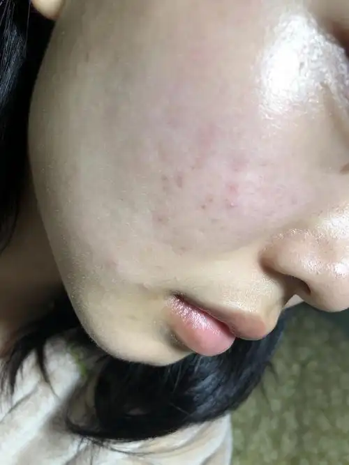 脸太干了涂了护肤品后发红发痒,有图慎入