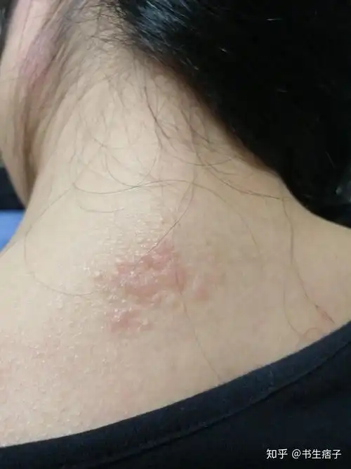 最近脖子上出了这种东西这个是什么啊