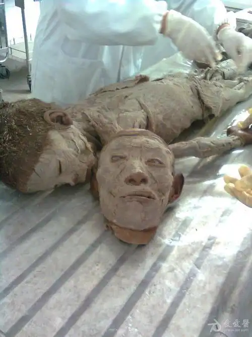 大体标本 - 临床病理讨论版 - 爱爱医医学论坛