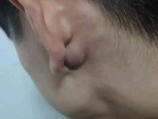 热心网友  2019-05-19   展开全部 你耳朵上的包块 好像是囊肿 ,侗滗