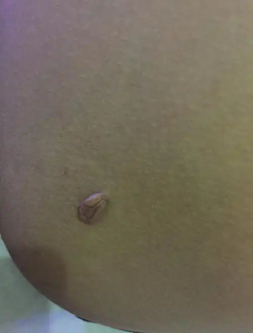 屁股上长个肉疙瘩怎么回事啊?求解.可不可以割掉啊!