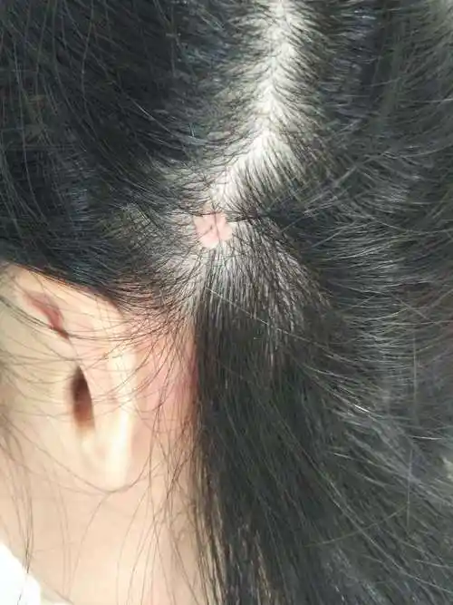 头皮上长的好像肉瘤一样的东西 十多年了 最初用手摸浅浅的 随