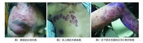 当带状疱疹病毒遇上艾滋病毒,将会出现什么样的叠加效应?