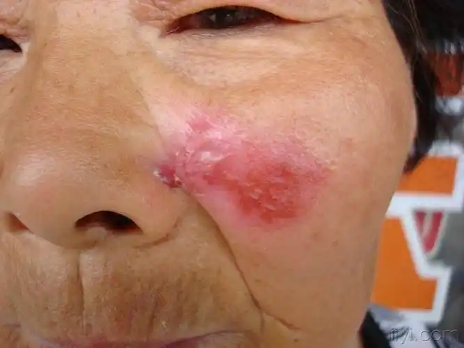 看图诊断9……公布答案:盘状红斑狼疮 - 皮肤及性传播疾病讨论版