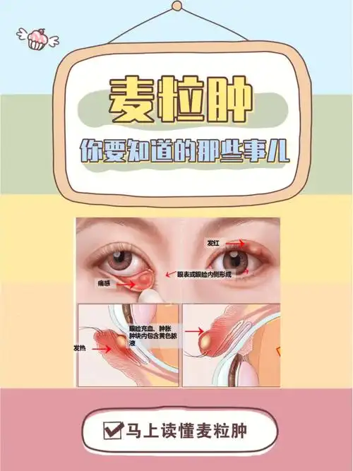 科普小知识丨得了麦粒肿71你了解它吗63