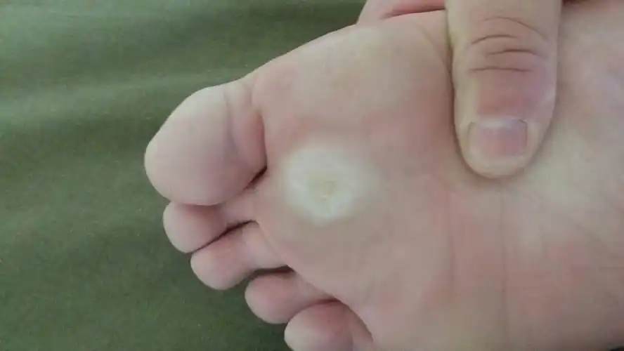 热水泡完脚后 脚掌发白 这是什么病症? 是脚气吗?