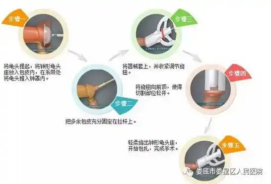 其原理是:把要切除的包皮内外板套在环切器内,用机械力量阻断阴茎皮肤