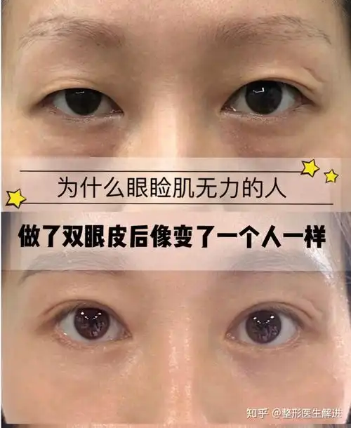 为什么眼睑肌无力的人做了双眼皮后像变了个人一样?