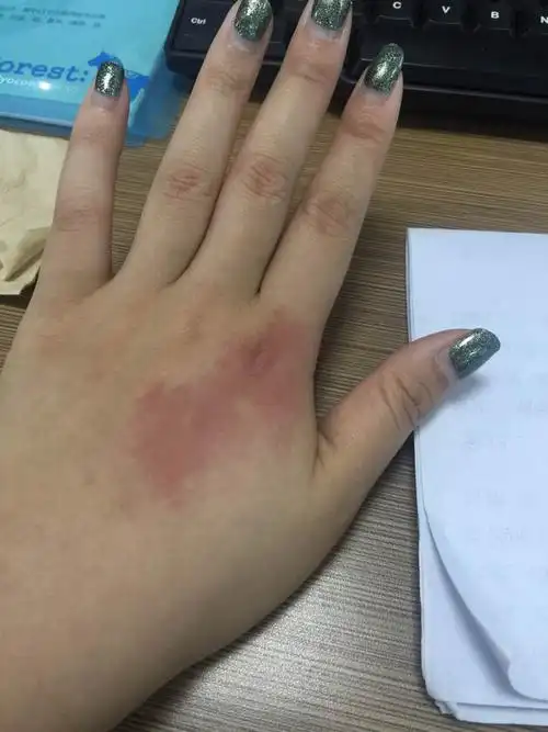 被植物叶子碰了一下手背就红了,上网查到是蚁酸,用肥皂水清洗了好多次