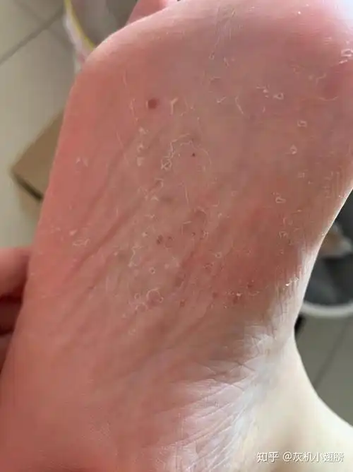 78有脚气别担心这样做就行了