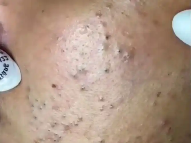 超解压的黑头清理粉刺清理挤黑头挤粉刺