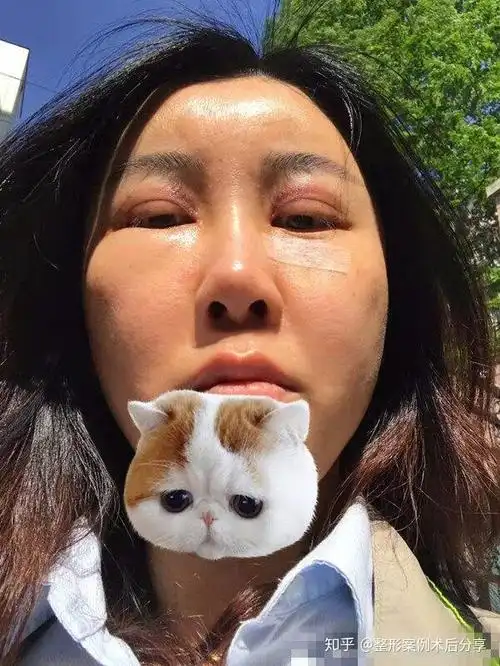 做双眼皮 脂肪填充1年多了,右边眼袋脂肪还是肿胀着,眼窝凹陷,眼皮