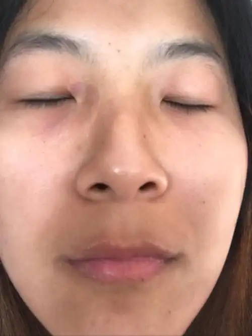 脸颊两侧有毛孔粗大里面还有黑毛