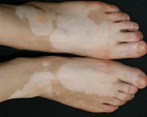 白癜风是一种获得性色素脱失性皮肤病,临床分为非节段型,节段型和未