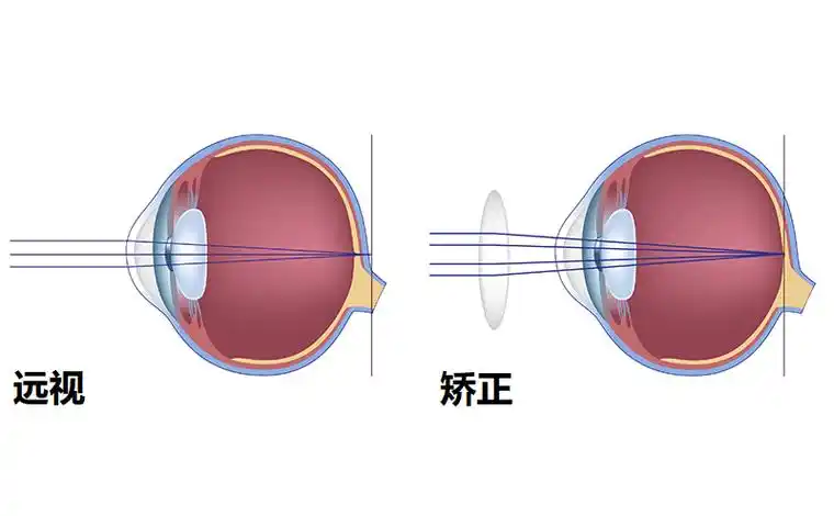 试听90秒【光学】激光矫正视力靠谱吗?先了解一下近视的原理