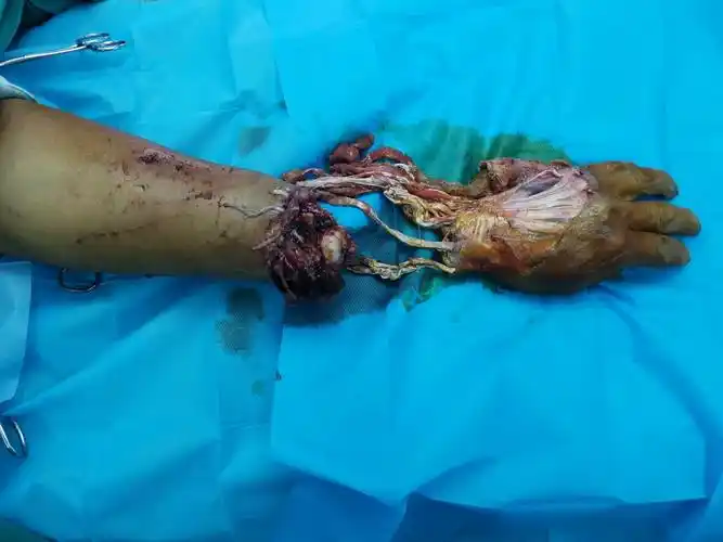 前臂离断伤病历分享