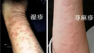 如何辨别荨麻疹和湿疹?_皮肤_症状_生活