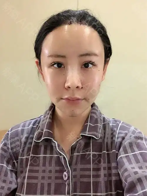 自体脂肪填充额头