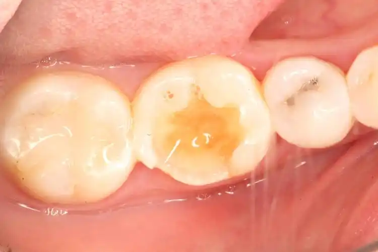 嵌体修复是什么?