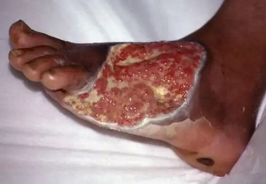 败血症图片 (69)