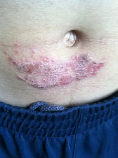 肚脐下面就是这样的,很痒,到底是怎么回事?应该用什么药呢?