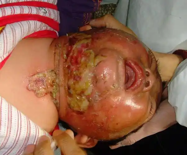 儿童烧伤怎么办留在手机里的必备育儿经验