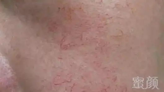 红血丝到底该怎么修复?