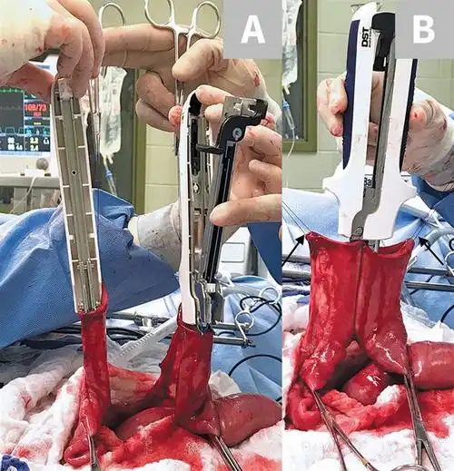 胃肠吻合术使用线型吻合器的六大步骤