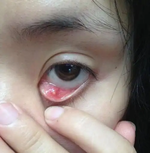 两个简便小偏方轻松治好麦粒肿