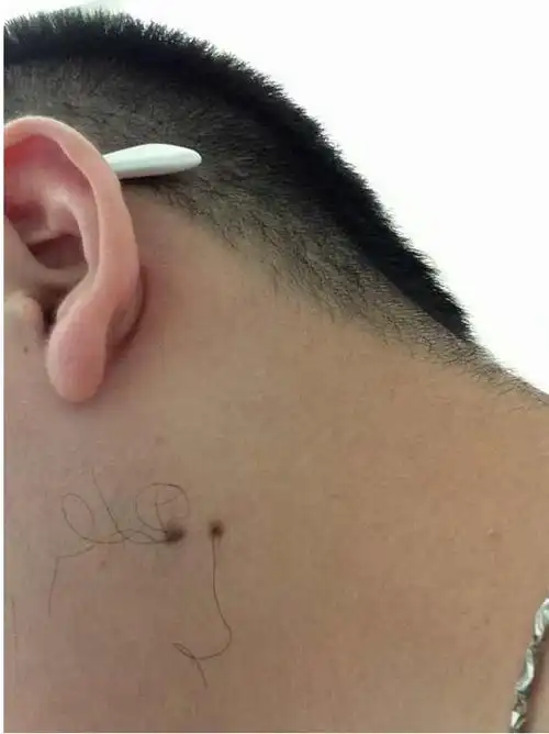 脖子痣上长毛好不好