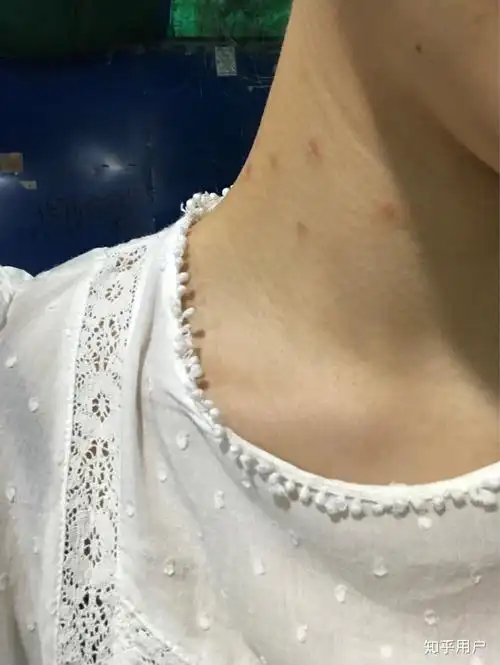 扁平疣爆发是什么样的啊