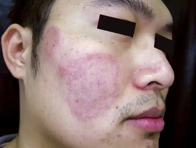 行医笔记:盘点 10 种面部炎性皮肤病