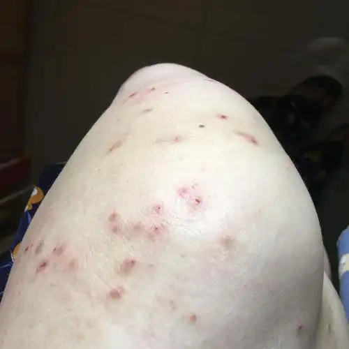 请问这是虫咬皮炎丘疹荨麻疹还是丘疹湿疹