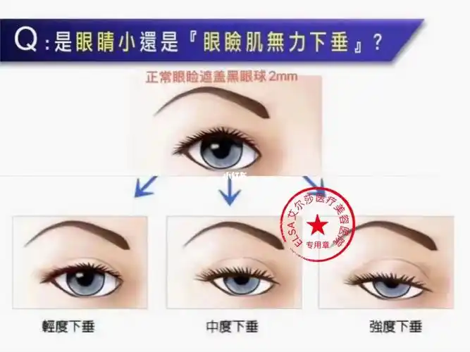 什么是眼提肌无力71_医美_肌无力_医疗美容_朝阳区艾尔莎医疗美容