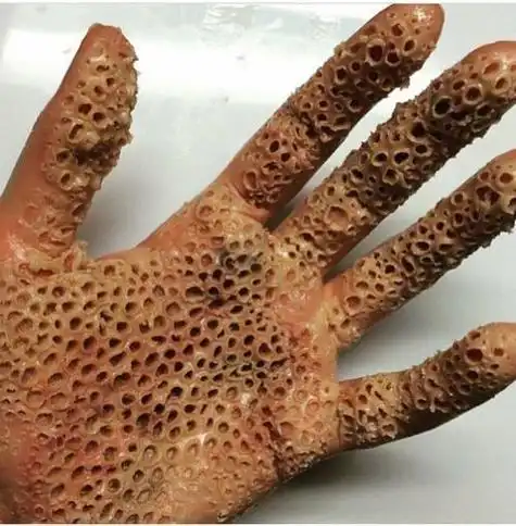 密集恐惧症到底是不是一种病