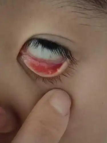 十岁孩子下眼睑内有两个白点,不疼不痒的,请问一下这是什么啊?