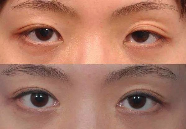 割双眼皮说是肌无力,双眼皮提肌有必要吗?什么叫提肌无力呢?