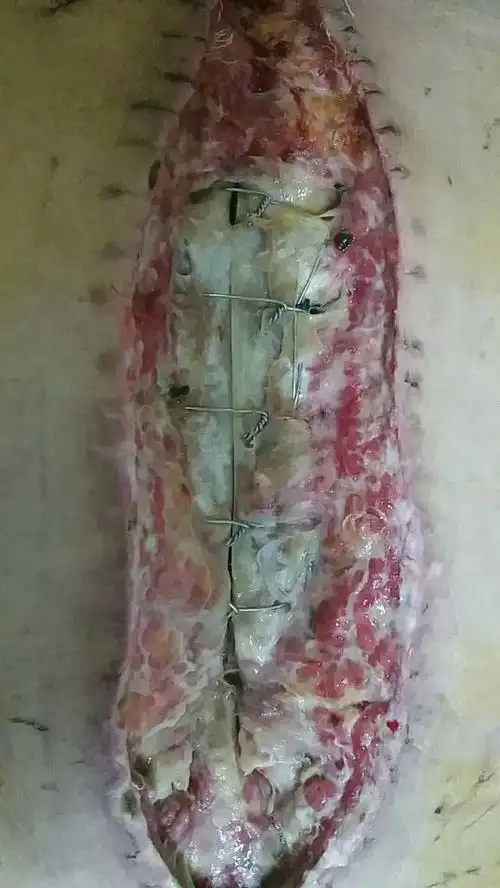 开胸手术后伤口裂开(胸骨骨髓炎)的外科治疗体会