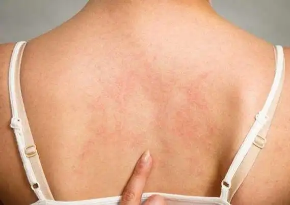 螨虫湿疹初期症状图片长什么样?-十月幸孕