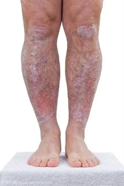 小孩各种皮肤病图片