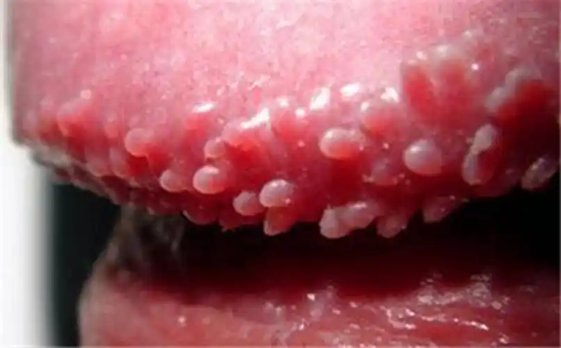 假尖锐湿疣白醋测试图片_有来医生